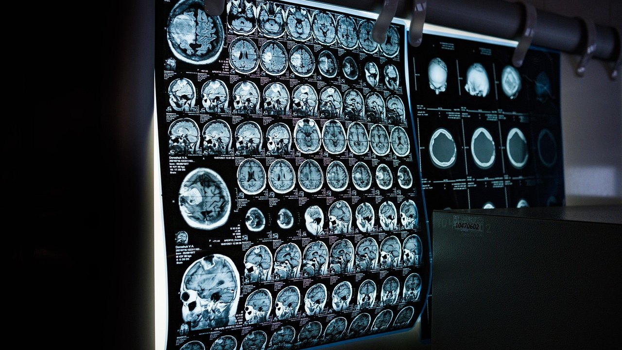 Atrial Fibrillation After Brain Bleed: DOAC vs Warfarin